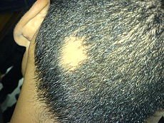Circular Hair Loss Seen In Alopecia Areata.