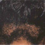 Hair-Breakage